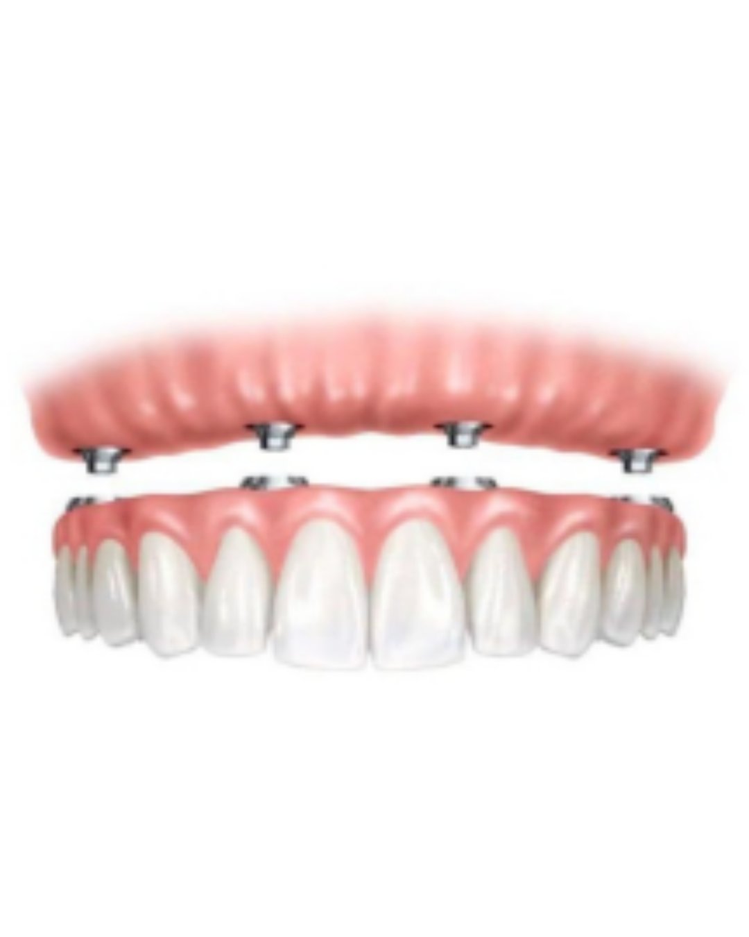 Reabilitação Completa